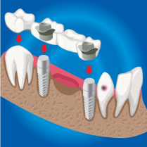 Dental Bridge