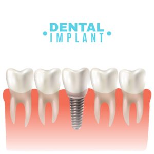 Dental Implant